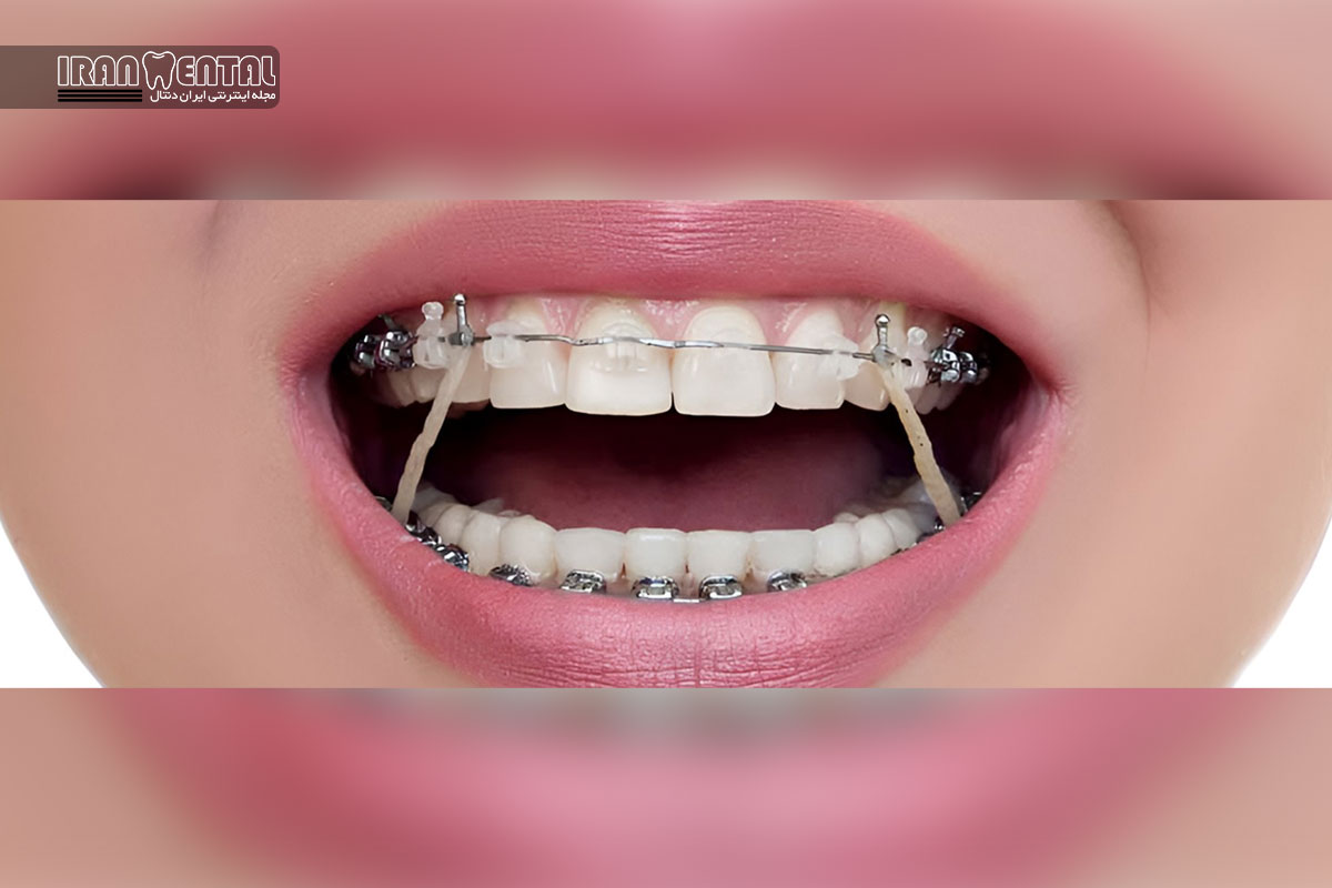 باندینگ دندان چیست و چقدر ماندگاری دارد؟ بررسی مزایا معایب هزینه و دوام واقعی باندینگ دندان