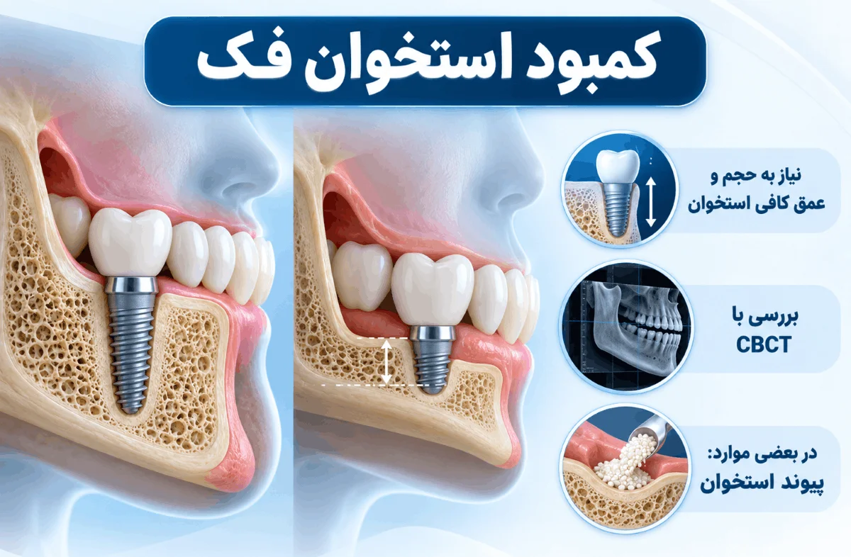 کمبود استخوان فک و بررسی شرایط لازم برای کاشت ایمپلنت