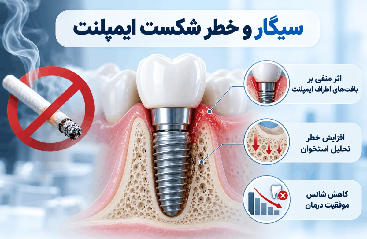 تاثیر سیگار بر افزایش خطر شکست ایمپلنت و تحلیل استخوان